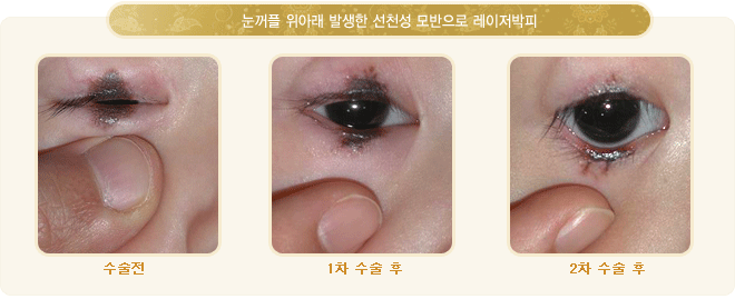 최근에는 거의 사용하지 않는 방법으로 드라이 아이스 혹은 액체질소를 이용하여 모반을 냉동시켜 피부와 함께 괴사시키는 방법입니다.